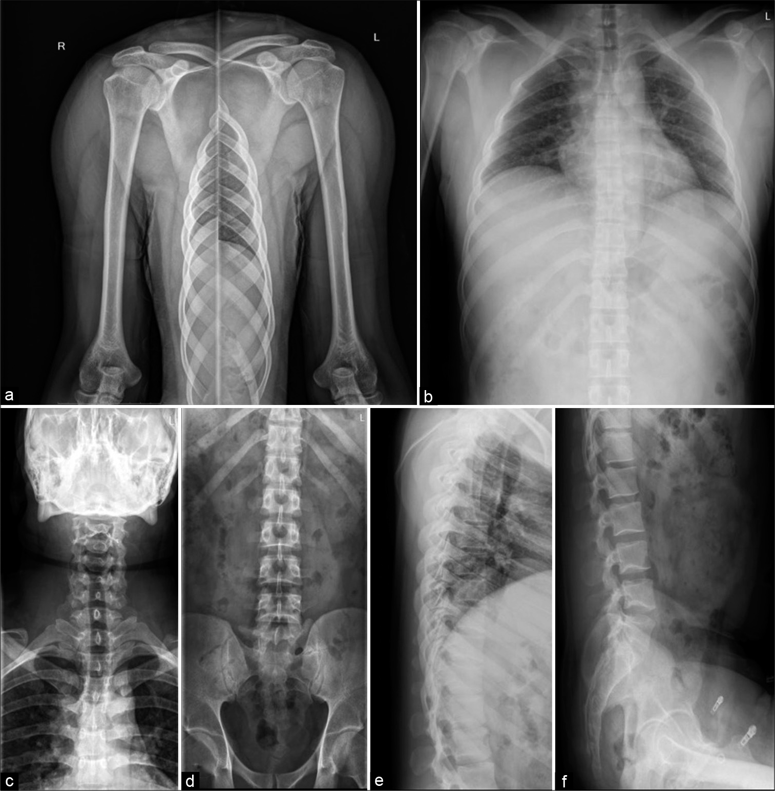 Frontal radiograph of both shoulder with humeri (a), Dorsal spine anterior-posterior (AP) (b) and Lateral view (e), Cervical spine AP (c), Lumbar spine AP (d), and lateral (f) radiographs appear unremarkable.