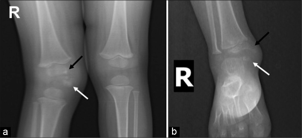 (a) Anteroposterior radiograph of both knee joints shows a lobulated irregular bony lesion in the medial knee (white arrow) with irregularity of medial aspect of femoral epiphyses (black arrow) along with genu valgum deformity. (b) Similar findings were seen in the ankle region with the bony lesion (white arrow) and irregular lower tibial epiphyses medially (black arrow).