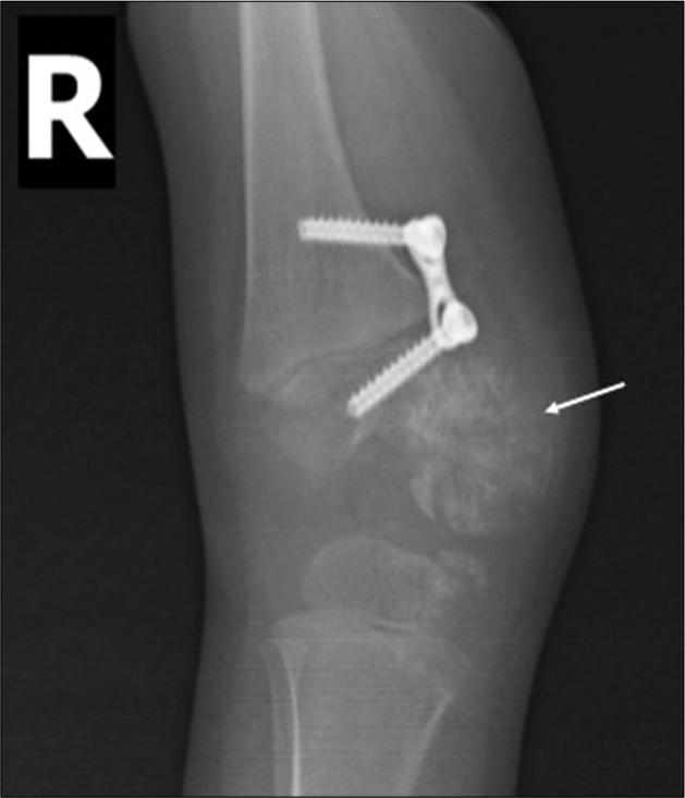 Anteroposterior and lateral views of the right knee after 10 months show interval increase in the size of the bony lesion (white arrow). Genu valgum correction screws noted.