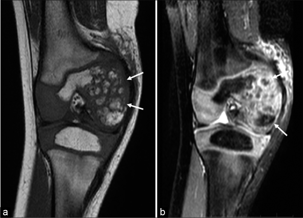 Coronal T1 (a) and PD fat-saturated sequences (b) show multiple conglomerate bony fragments related to the lower femoral epiphyses medially (white arrows) with cartilage continuity around the fragments.