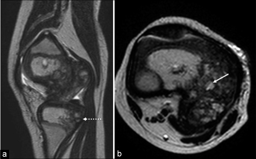 Sagittal (a) and axial (b) T2-weighted image shows similar changes in upper tibial epiphyses (dotted arrow). The fragments show normal marrow signal (white arrow).