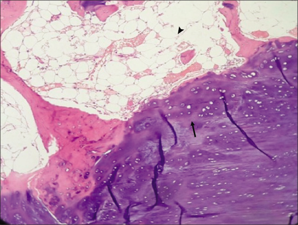 Histopathology shows features of osteochondroma with cartilage capping (arrow) and mature marrow adipocytes (arrowhead).