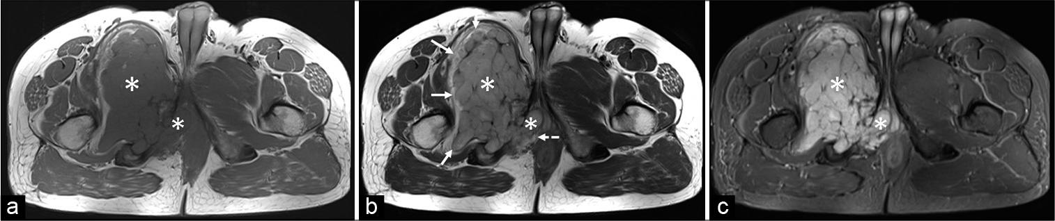 A 43-year-old man with intraosseous schwannoma of the right inferior pubic ramus who presented with a swelling in the right groin. (a) Non-contrast MRI axial T1-weighted image shows an altered signal intensity lesion in the right pubic bone involving the body and inferior pubic ramus with a narrow zone of transition and a large intra and extrapelvic soft-tissue component (white asterisks) which is isointense to the skeletal muscle. (b) Non-contrast MRI axial T2-weighted image shows the soft tissue (white asterisks) is mildly hyperintense to the skeletal muscle. The soft-tissue component is compressing and displacing the muscles of the thigh with well-maintained fat planes (white arrows). The intrapelvic component shows maintained fat planes with the anal sphincter (dashed white arrow). (c) Non-contrast MRI axial short-tau inversion recovery image shows the soft tissue (white asterisks) is markedly hyperintense to the skeletal muscle.