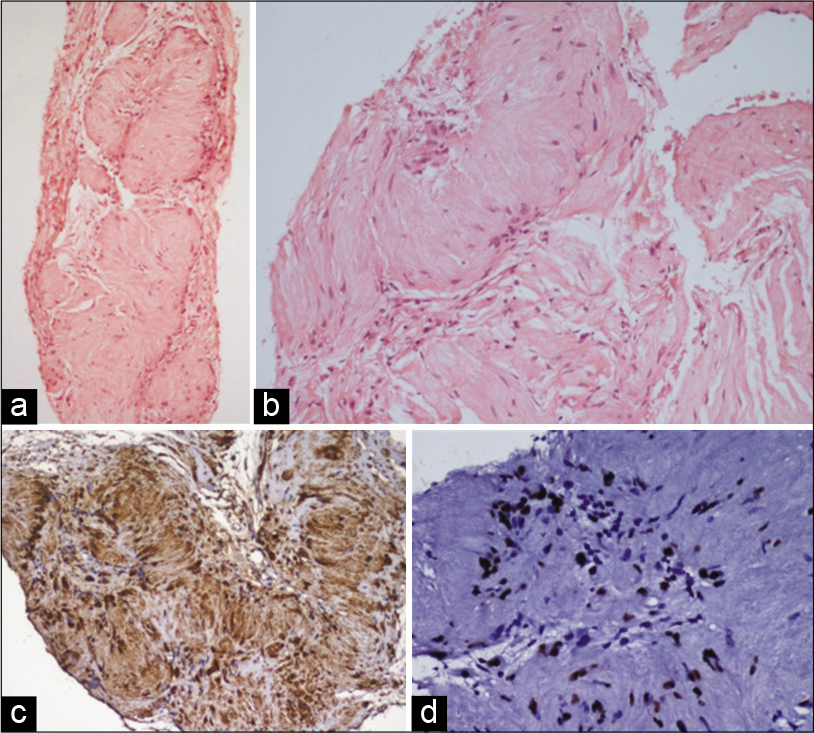 A 43-year-old man with intraosseous schwannoma of the right inferior pubic ramus who presented with a swelling in the right groin. Histopathology sections show (a) and (b) sections of core biopsy showing multiple Verocay bodies characterized by palisaded arrangement of bland spindle cells representing Antoni A areas. Cells represent Antoni B areas (H&E; a×40, b×200). (c) IHC with S100 showing diffuse strong nuclear and cytoplasmic positivity in spindle cells and (d) IHC with SOX10 showing strong nuclear positivity in the spindle cells (poly HRP; c×200, d×400).