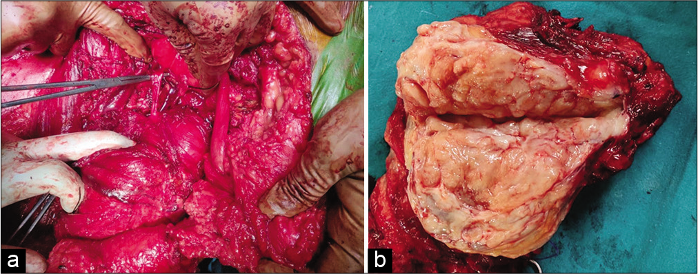 A 43-year-old man with intraosseous schwannoma of the right inferior pubic ramus who presented with a swelling in the right groin. (a) Intraoperative photograph shows the continuity of the lesion with the right obturator nerve (tip of artery forceps). (b) Photograph of cut section of gross specimen shows tan white material which was gritty and fibrous in nature.