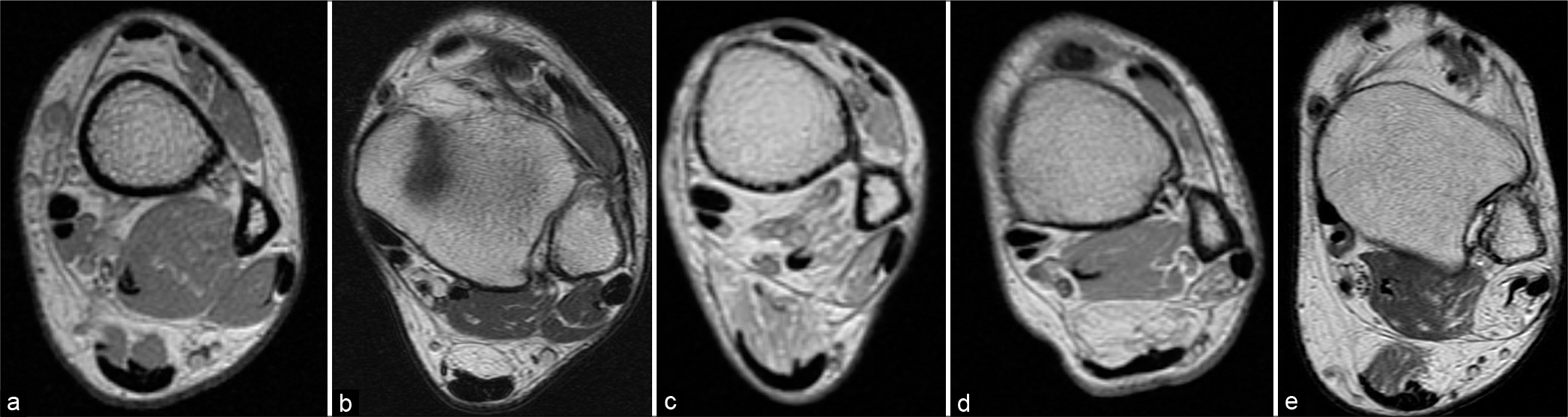 Peroneus brevis muscle fatty atrophy grading. (a) Grade 0, absence of intramuscular fat. (b) Grade 1, muscle contains some fatty streaks. (c) Grade 2, < 50% muscle fatty atrophy. (d) Grade 3, 50% muscle fatty atrophy. (e) Grade 4, >50% muscle fatty atrophy.