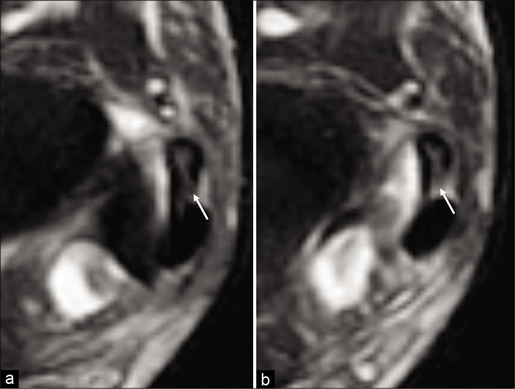 A 35-year-old man with a surgically confirmed partial thickness tear of the peroneus brevis tendon following an acute soccer injury. Consecutive axial T2-weighted fat saturated MR images from superior (a) to inferior (b) of the inframalleolar lateral ankle demonstrate the cleft sign, manifested as intermediate signal within the peroneus brevis tendon spanning at least 50% of the tendon and breaching the posterior tendon surface (white arrow), present on both slices.