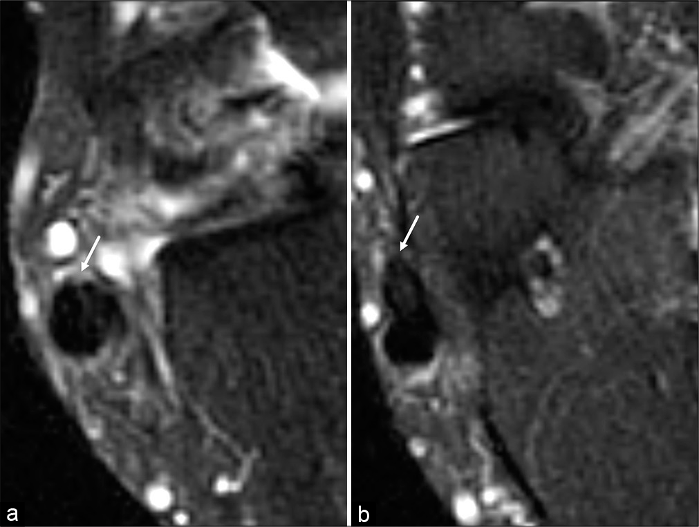 A 61-year-old man with a surgically confirmed partial thickness tear of the peroneus brevis tendon following a work-related injury. Consecutive axial T2-weighted fat saturated MR images from superior (a) to inferior (b) of the inframalleolar lateral ankle demonstrate a positive cleft sign (white arrow). This case was called negative for a peroneal tendon tear on both the original report and by both readers.