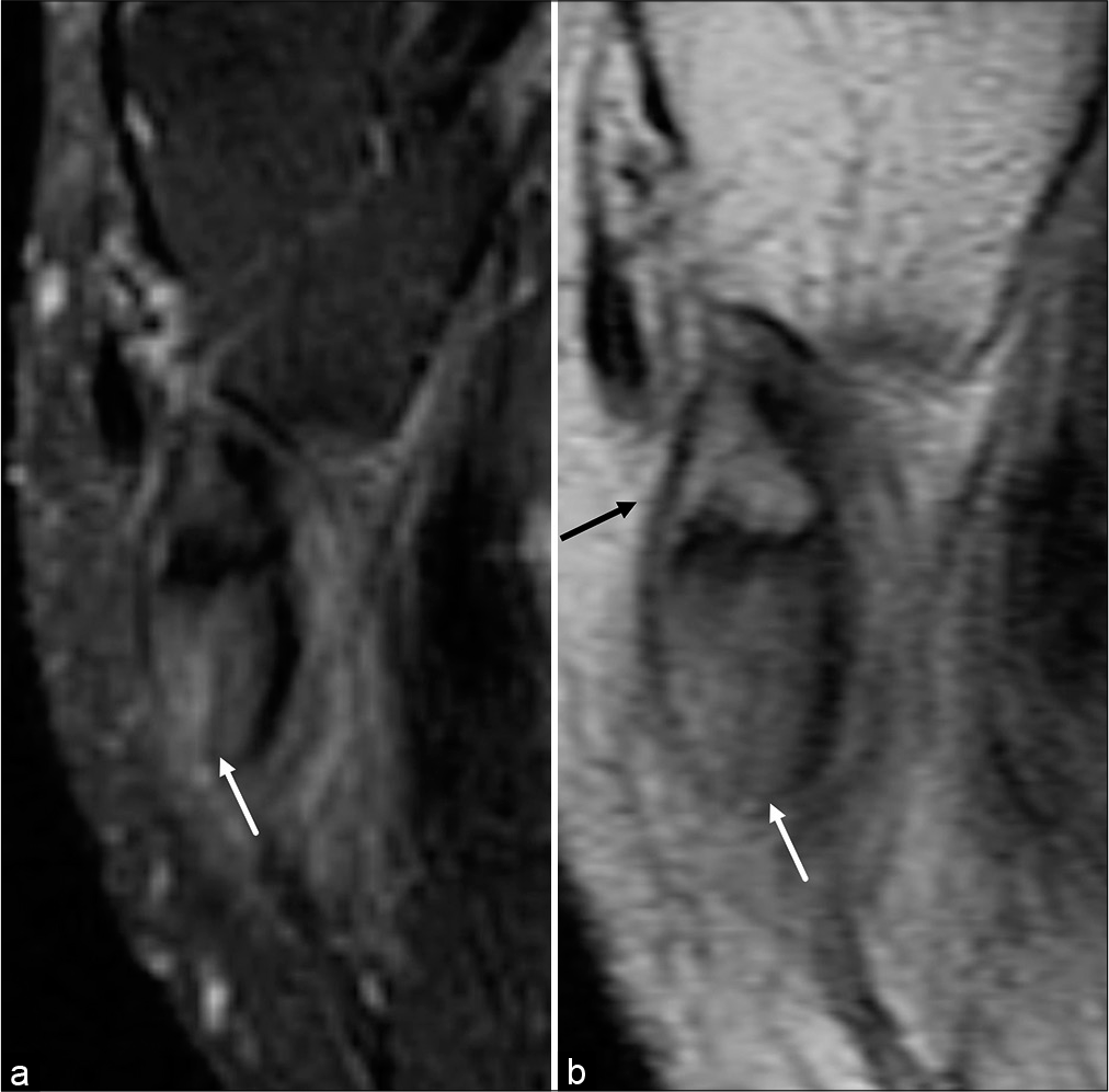 A 48-year-old man with surgically confirmed peroneus longus tenosynovitis with an intact tendon. Axial T2-weighted fat saturated (a) and axial intermediate-weighted (b) MR images of the peroneus longus tendon distal to the peroneal tubercle demonstrate a falsely positive cleft sign (white arrow). The peroneus longus tendon fans out before surrounding an os peroneum (black arrow).