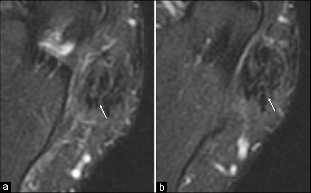 A 41-year-old man who had previously undergone peroneus brevis and longus repair with tendon transfer presented with a work-related injury. Second look surgery demonstrated an intact tendon with extensive intratendinous scarring. Consecutive axial T2-weighted fat saturated MR images from superior (a) to inferior (b) of the inframalleolar lateral ankle demonstrate a false positive cleft sign in the peroneus brevis tendon (white arrow).