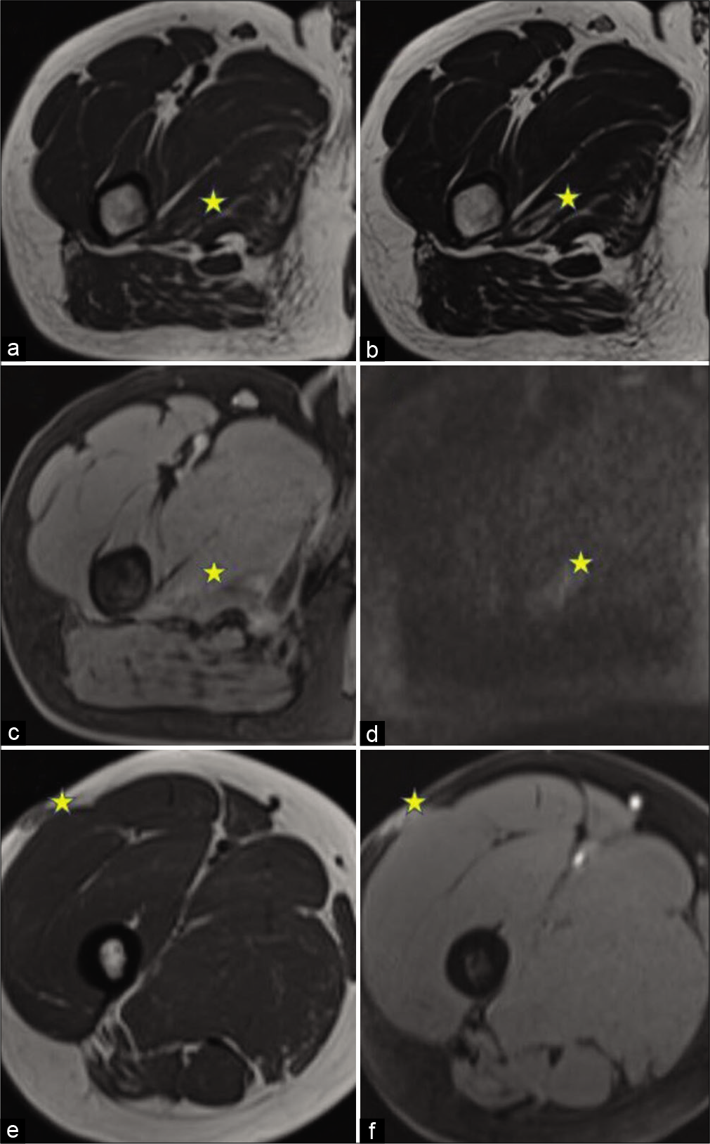 A 35-year-old man with swelling in the right thigh. magnetic resonance imaging of the lesion. The lesion is marked with stars. (a) Axial T1WI shows a lesion within the right adductor magnus muscle, with central iso- to hypointense and peripheral hyperintense signal. (b) Axial T2WI shows a hyperintense signal in the lesion with the central hypointense signal. (c) Axial T1W post-contrast image shows Mild peripheral enhancement. (d) Axial DWI, showing: Patchy areas of diffusion restriction. (e) Axial T1WI showing the primary subcutaneous lesion with heterogeneous post-gadolinium enhancement (f).