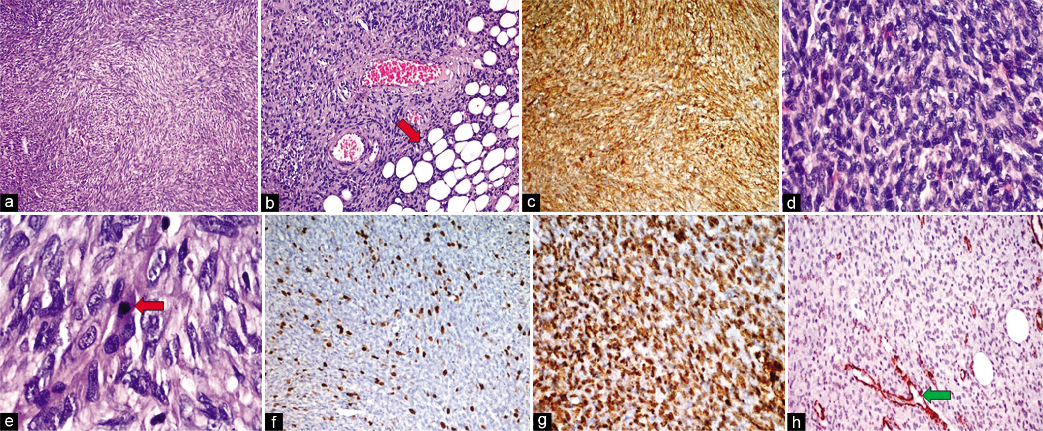 HPE from lesion in the upper back of Case 1. Hematoxylin and eosin (H&E) stained sections demonstrate a proliferation of spindle-shaped cells with elongated nuclei and mild pleomorphism, arranged in a storiform to the whorled pattern (a ×100). This lesion infiltrates the underlying subcutaneous fat (red arrow), producing a honeycomb-like design (b ×200). Immunohistochemistry (IHC) shows strong and diffuse positivity for CD34 indicating spindle cell proliferation (c). The areas of the sarcomatous component showed marked nuclear pleomorphism (H&E; d ×400), and higher magnification showed hyperchromatic nuclei with atypical mitosis (red arrow) (H&E; e ×1000). The index of ki-67 proliferative activity was approximately 10–12% positive (f). IHC in sarcomatous areas showed diffuse immunopositivity for smooth muscle actin (SMA) (g) and were immunonegative for CD34 (h) (positive control blood vessels – green arrow).