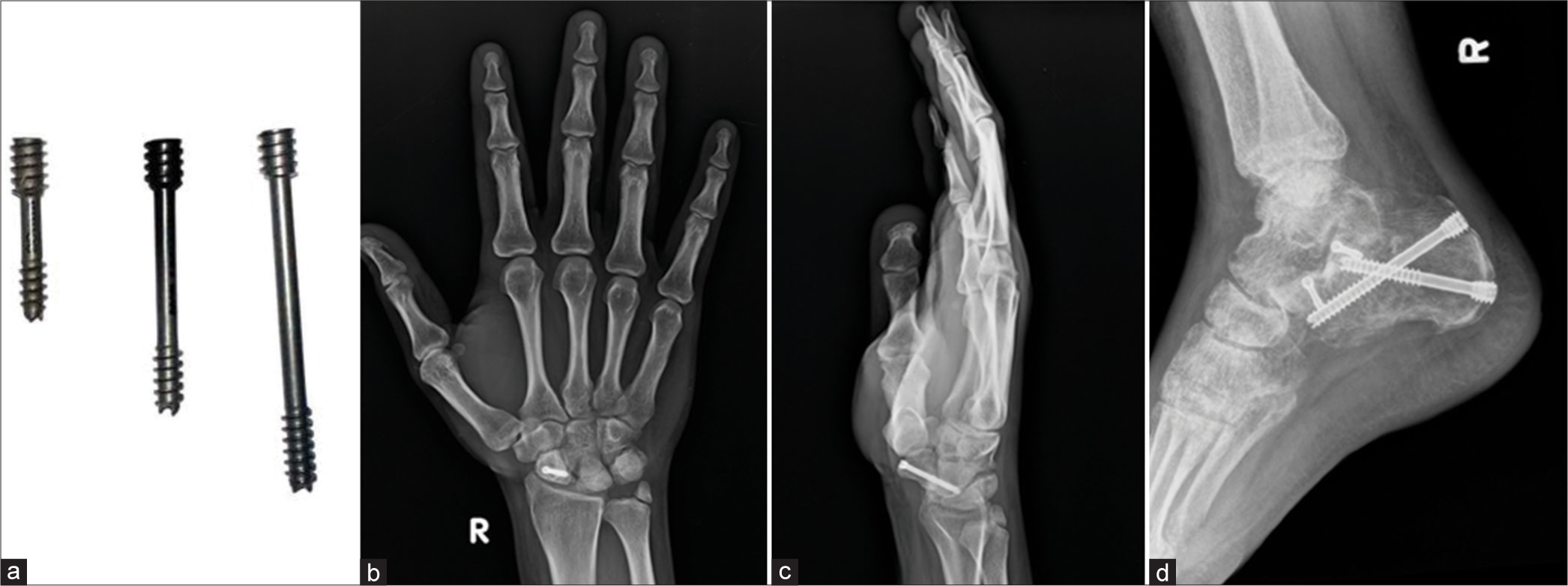 (a) Herbert screws (b and c) anteroposterior and lateral views of the right wrist showing Herbert Screw in scaphoid fracture. Also note the non-united ulnar styloid fracture. (d) Lateral view of the ankle. Herbert screws used in fracture calcaneum. Note that the larger width and greater pitch proximally than distally. Hence as the screws closes in to the bone, the differential pitch allows greater compression at fracture site.