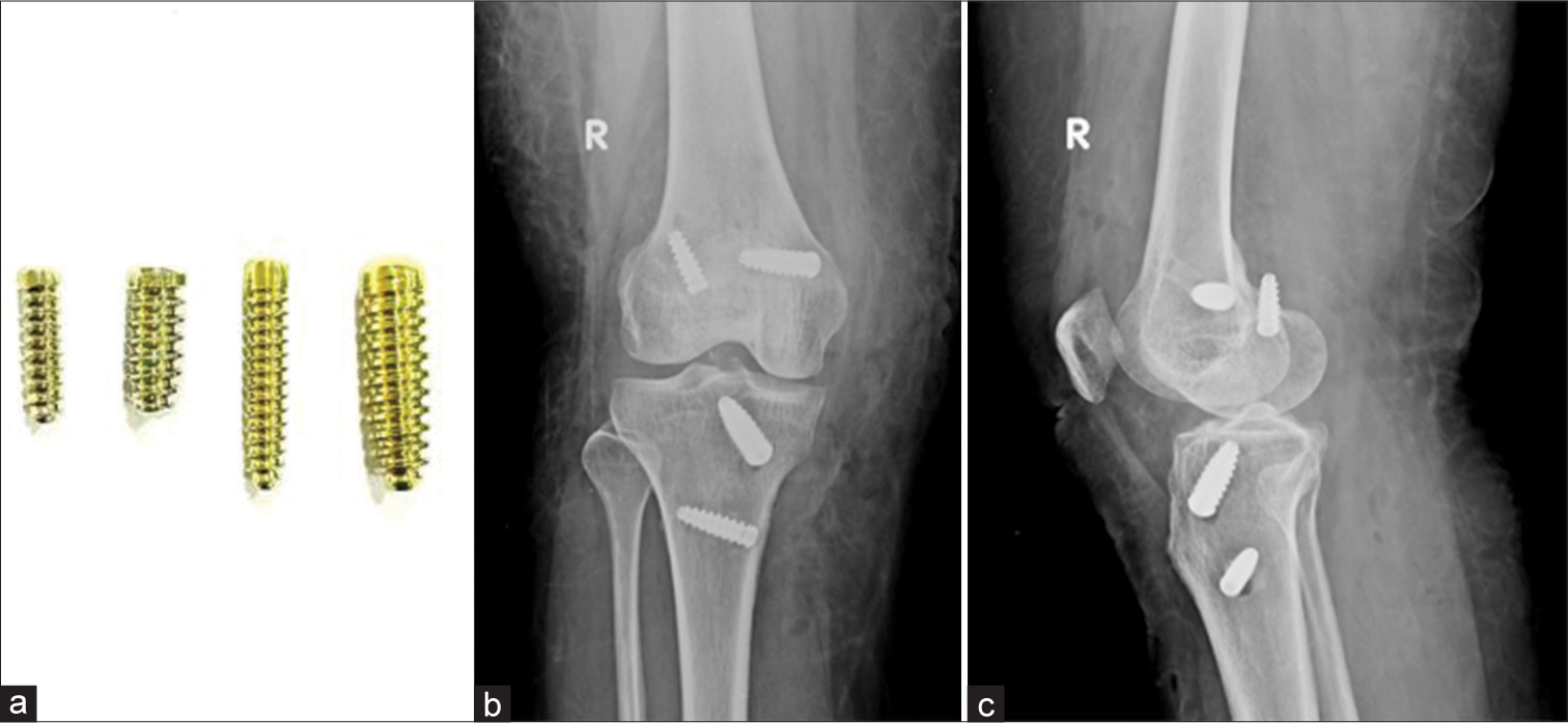 (a) Titanium interference screw. (b and c) AP and Lateral radiographs of the knee. Post anterior cruciate ligament and middle collateral ligament reconstruction with titanium interference screw in situ. Note that the femoral screw in the lateral condyle on lateral view has breached the cortex.