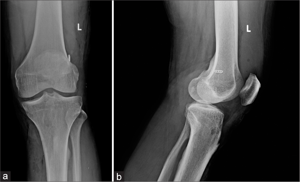 AP (a) and lateral (b) radiographs of the knee showing Post anterior cruciate ligament reconstruction performed using bioabsorbable screws. The grafts used for ligamentous reconstruction are placed within these tunnels and held by these screws. These tunnels can be identified as radiolucent, parallel tracks. Also identify the radio-opaque endobutton along the lateral femoral cortex at the femoral tunnel.