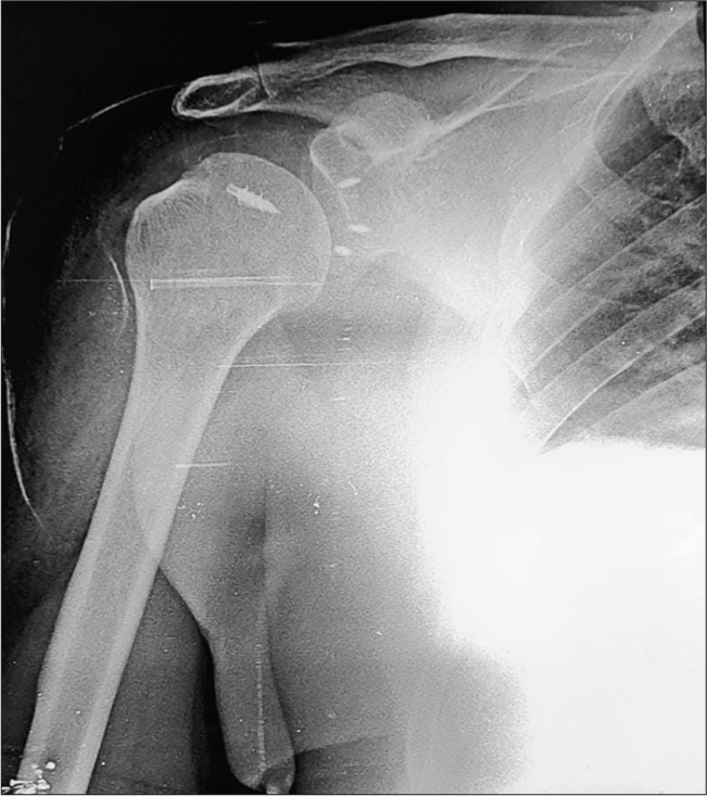 Anteroposterior radiograph of the right shoulder post arthroscopic surgery for anterior instability (Bankart fixation and humeral remplissage). Note the titanium suture anchors in the humeral head (5 mm) and glenoid (2.8 mm). Suture anchors are screw like structures with suture threads loaded into them used to anchor soft-tissue to the bone.