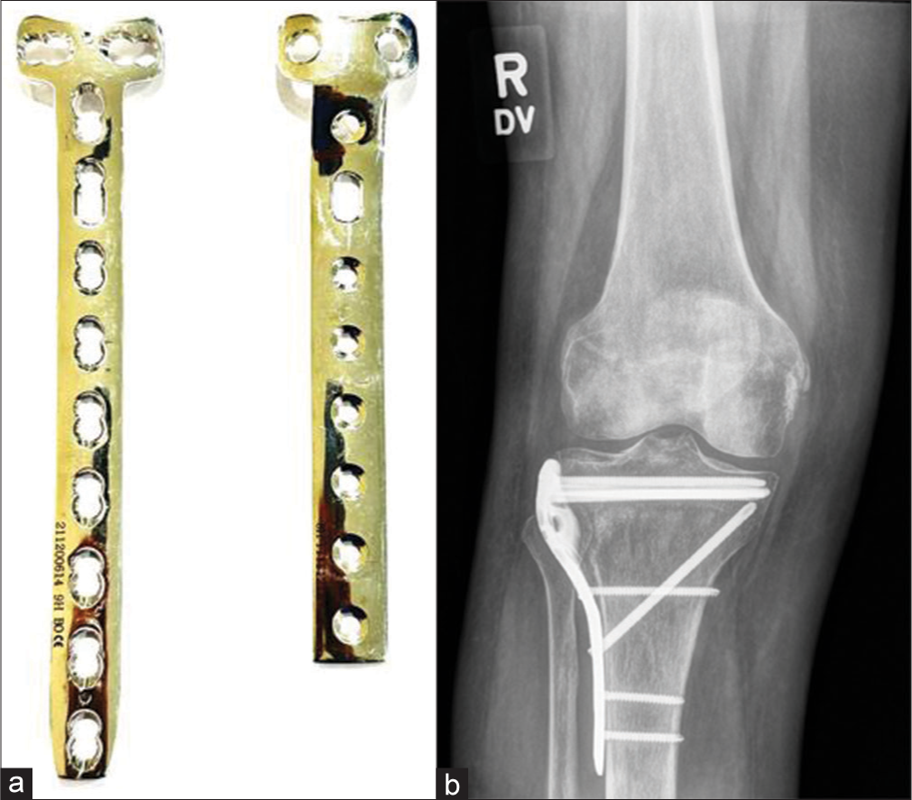 (a) Buttress plate (b) Anteroposterior view of the knee showing fracture of the proximal tibia with buttress plate in situ. Note cancellous screws in the proximal aspect while cortical screws have been used in the diaphysis.
