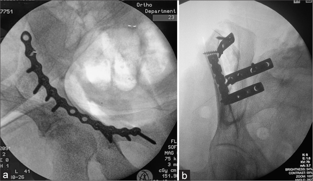 Fluoroscopic figures showing (a) reconstruction plating of the anterior column of the acetabulum via anterior intrapelvic approach (b) acetabular anterior column pelvic fractures fixed with reconstruction and dynamic compression plates. Note the difference in borders. The notching on the reconstruction plate allows sidewards bending and curving of the plate on uneven surfaces.