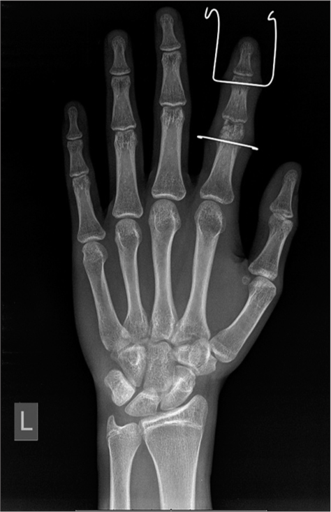 Anteroposterior radiograph of the left hand showing fractures of the heads of the proximal and middle phalanges with K wires used as external fixation devices to maintain traction and reduction.