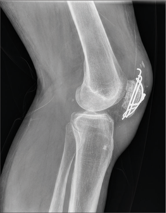 Lateral radiograph of knee with tension band wiring for patellar fracture.