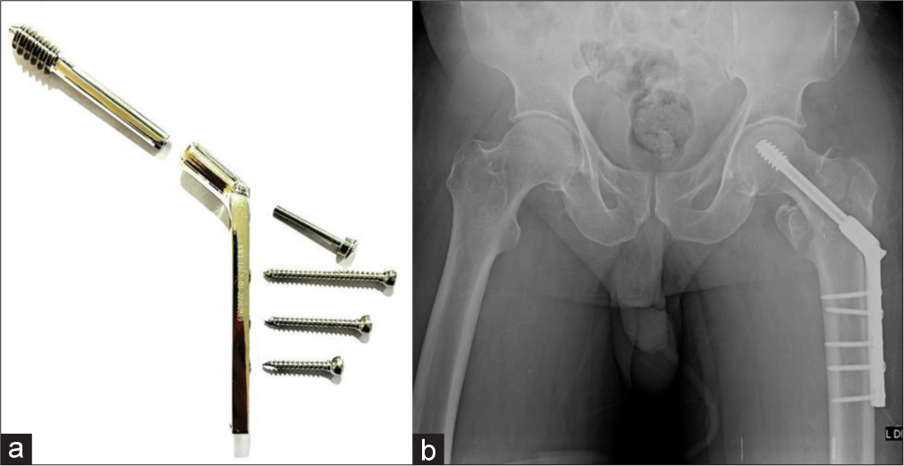 (a) Dynamic hip screw (DHS) system (b) anteroposterior radiograph of the pelvis with intertrochanteric fracture status post-surgery with DHS.