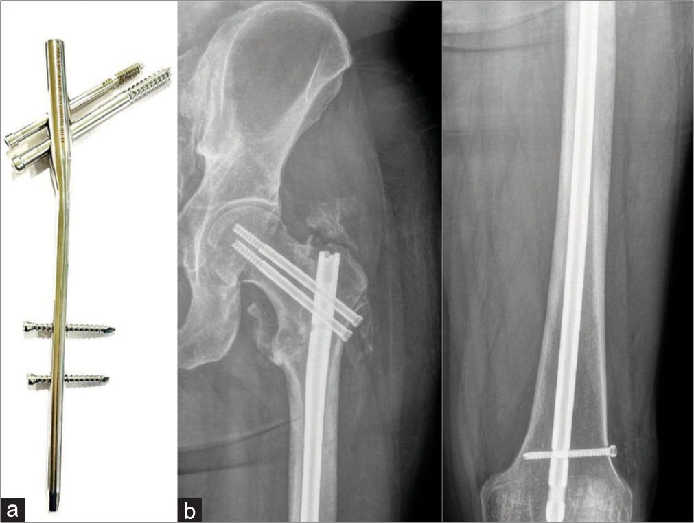 (a) Proximal femoral nail (PFN) system (b) anteroposterior radiographs of the left hip joint and femur showing peritrochanteric fracture with PFN in situ. Note the central position of the screws. With the routine intramedullary nail only diaphyseal fractures can be fixed. With this system, peri trochanteric fractures can also be fixed. Note the peritrochanteric heterotopic ossification.