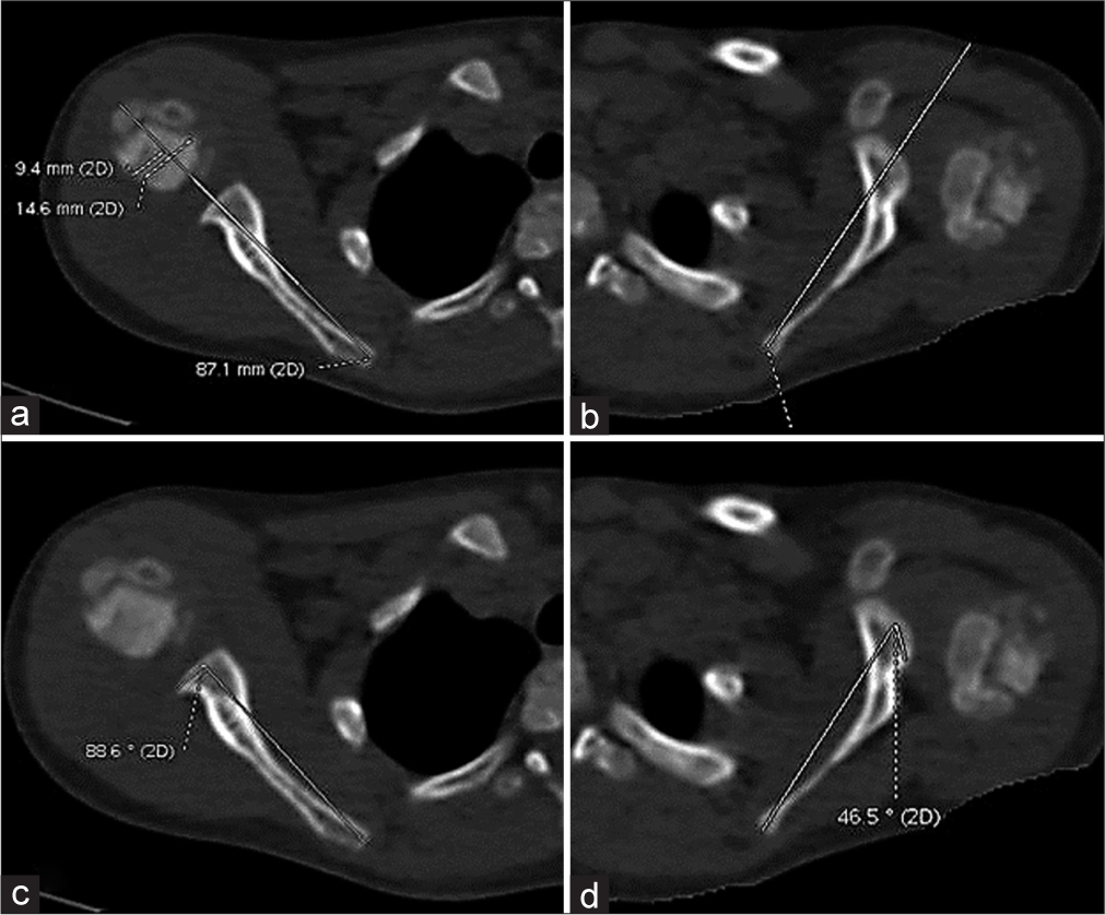 Computed tomography axial images of a 5-year child with the left obstetric brachial plexus injury. (a) Percentage of humeral head anterior to the scapular line (PHH) in normal side [right]. (b) PHH in affected side [left] showing posterior shoulder dislocation. (c) Glenoscapular angle (GSA) in normal side [right] 1.4° retroversion. (d) GSA in affected side [left] showing increased glenoid retroversion of 43.5°.