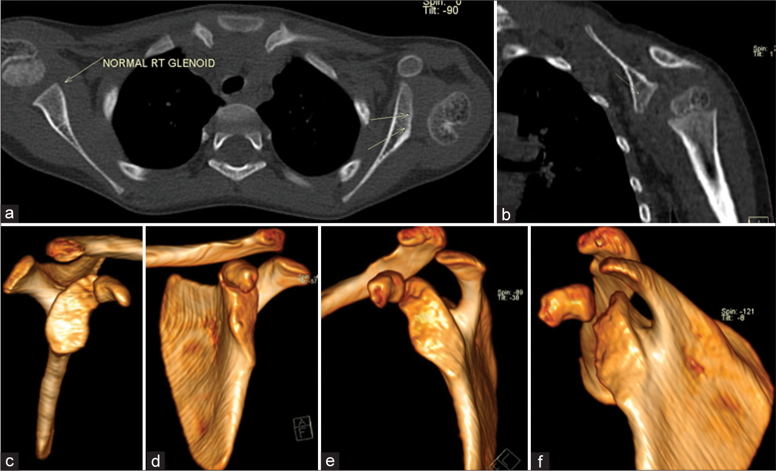(a) Computed tomography axial image showing normal right glenoid, retroverted and dysplastic left glenoid with posterior dislocation of humeral head. (b) Coronal reformatted image showing retroverted glenoid. (c) Virtual reality (VR) image showing normal right glenoid cavity. (df) VR image showing retroverted glenoid with false glenoid cavity formation in the inferior aspect of anatomic glenoid.