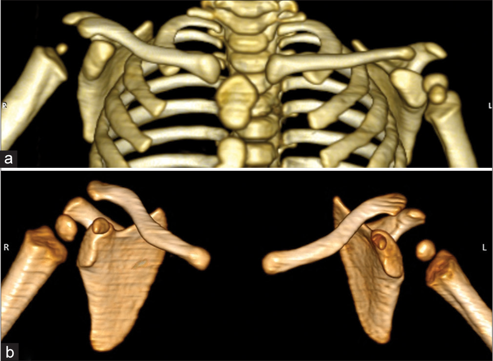 Computed tomography virtual reality images. (a) Child with the right obstetric brachial plexus injury (OBPI) with hypoplastic right humeral head, absent greater tuberosity epiphysis and retroverted right glenoid cavity. (b) Child with the left OBPI with hypoplastic and retroverted left glenoid cavity.