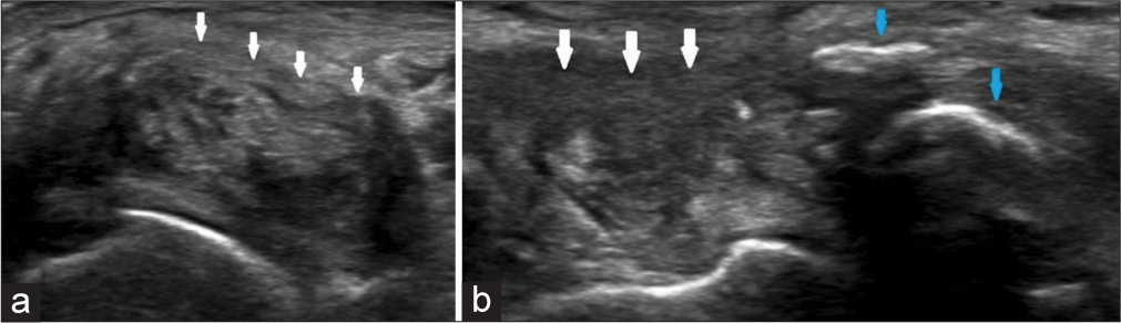 Transverse (a) and longitudinal (b) ultrasound images of the tibialis posterior tendon, which is thickened and heterogeneous, consistent with tendinosis (white arrows). Also seen are the ossicles, as dense intratendinous structures with acoustic shadowing (blue arrows).