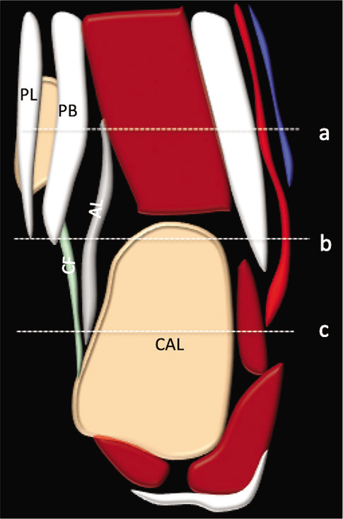 Coronal schematic image showing accessory ligament (AL), CF (CFL), PB (peroneus brevis), PL (peroneus longus) and CAL (calcaneum). Axial images [Figures 3 and 4] at different levels (a,b,c).