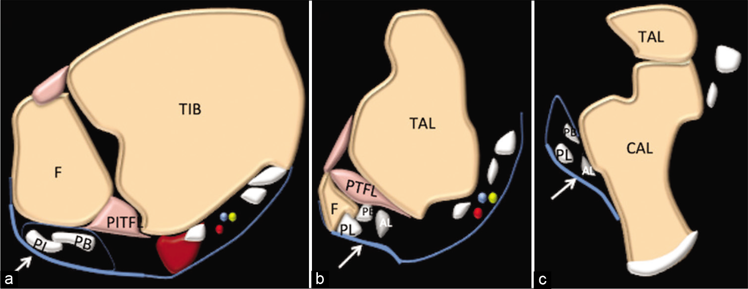 Axial schematic at different levels showing thickened peroneal retinaculum (small arrow) and accessory ligament (AL). Tibia, fibula, peroneus brevis, peroneus longus (a-c) (Ref to Figure 2).