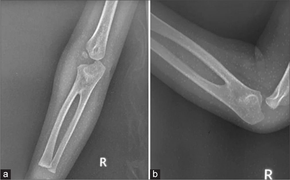 Plain radiograph of the right elbow showing proximal radioulnar synostosis of 5 cm in anteroposterior view (a) and lateral view (b).