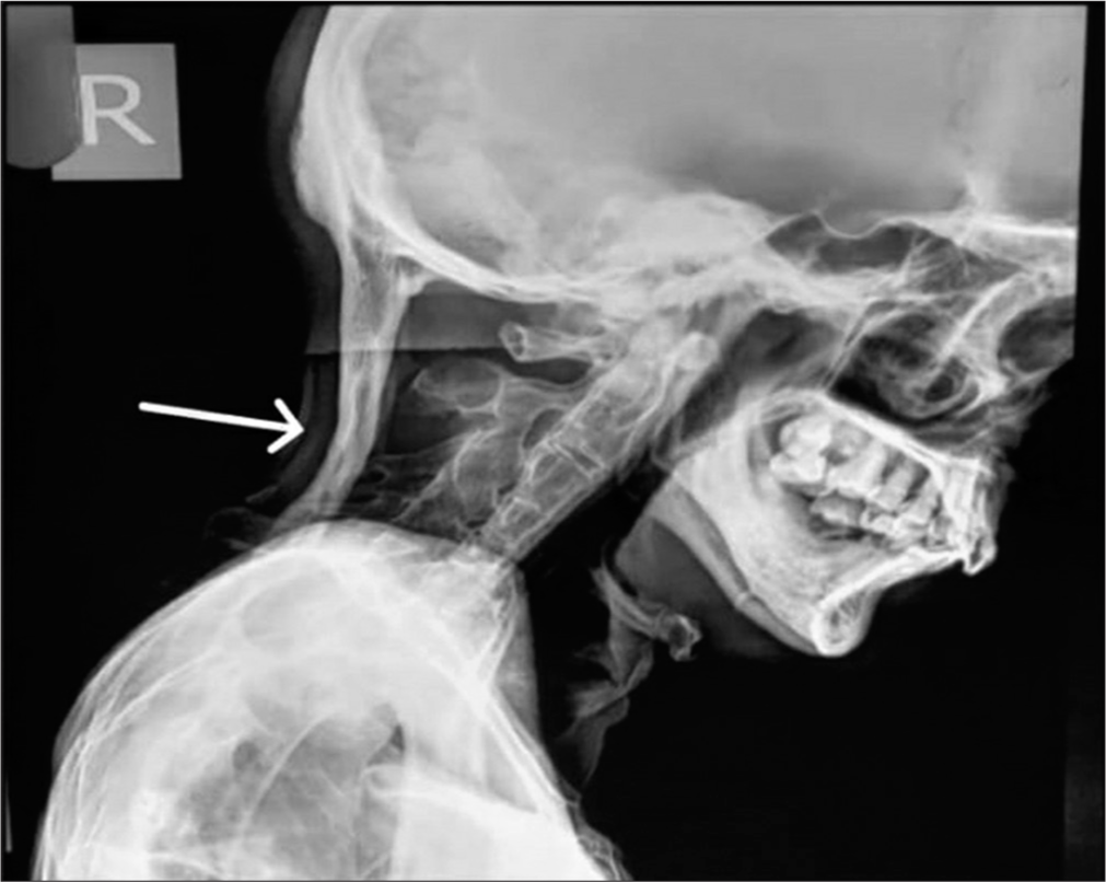 Posteromedial knee friction syndrome: Diagnosis by magnetic