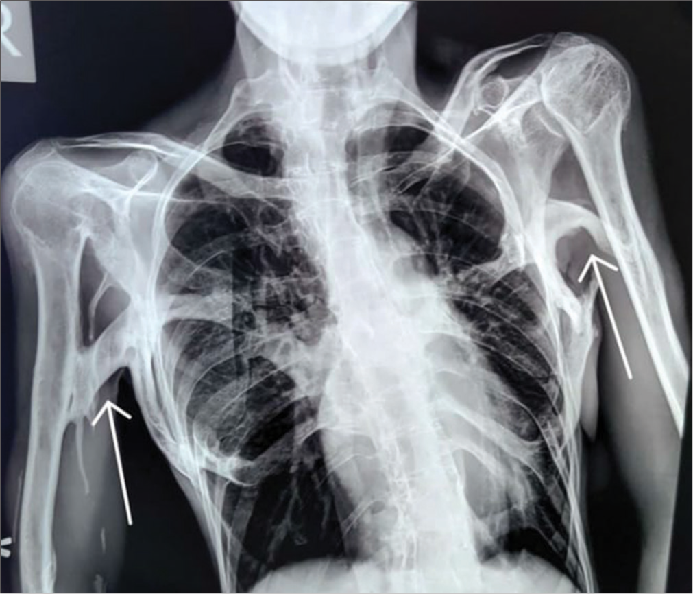 Chest X-ray (PA view) shows thick bands of heterotopic ossification resulting in bridging of rib cage to humerus on either side and limiting lateral arm mobility.