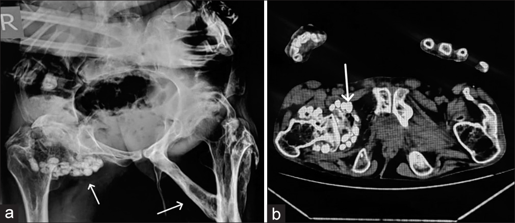 (a and b) X-ray pelvis AP view (a) with axial computed tomography image (b) shows broad femoral necks with thick bands of ossification extending from left pubic symphysis to mid femoral shaft along with soft-tissue ossification along medial aspect of thigh and left peri-trochanteric region with multiple osteochondral bodies and associated osteoarthritic changes along deformed and remodeled right hip with periarticular osseous ankylosis.