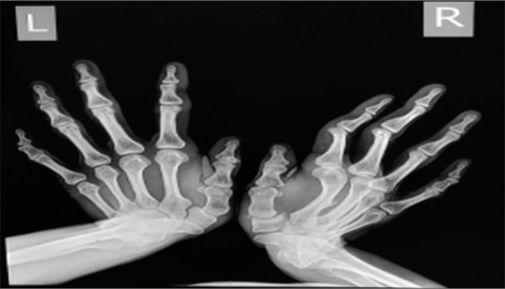 X-ray of both hands shows microdactyly of both thumbs with fused bilateral wrist joints. The metacarpals of both hands appear short and broad with asymmetrically pronounced shortening of 1st metacarpal of bilateral hands.