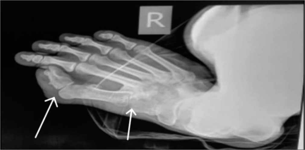 X-ray of foot shows hallux valgus deformity with microdactyly due to short broad proximal phalanx and absent distal phalanx and there is synostosis of the metatarsal bases with tarsal bones.