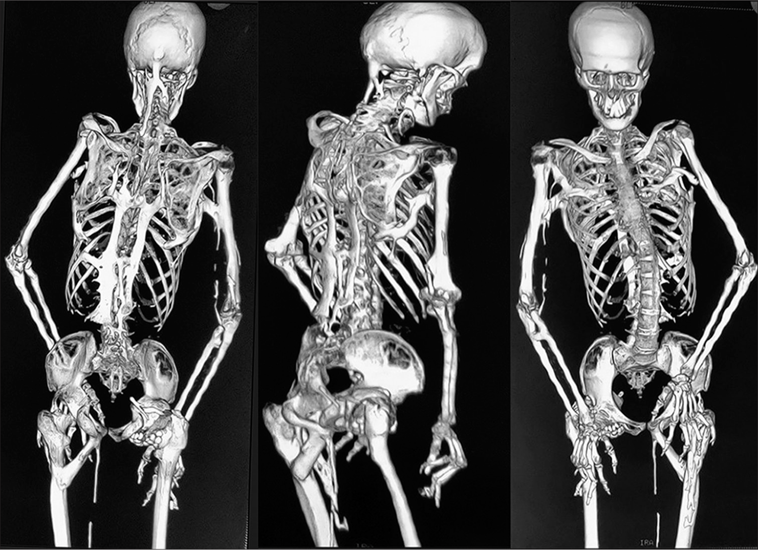 The 3D-reconstructed computed tomography scan in posterior, oblique and anterior view reveals the extent of heterotopic ossification from occiput to femoropelvic junction.