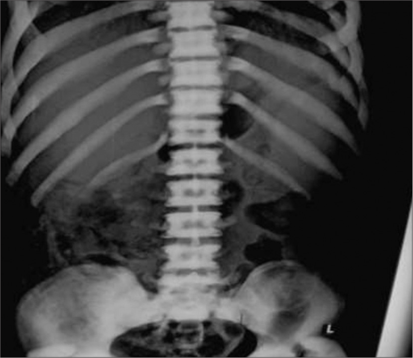 X-ray abdomen showing mottled air shadows in the right iliac fossa with sclerosis in visualized ribs and loss of corticomedullary differentiation giving sandwich appearance of the vertebrae. Alternating bands are also noted in visualized bilateral iliac wings.