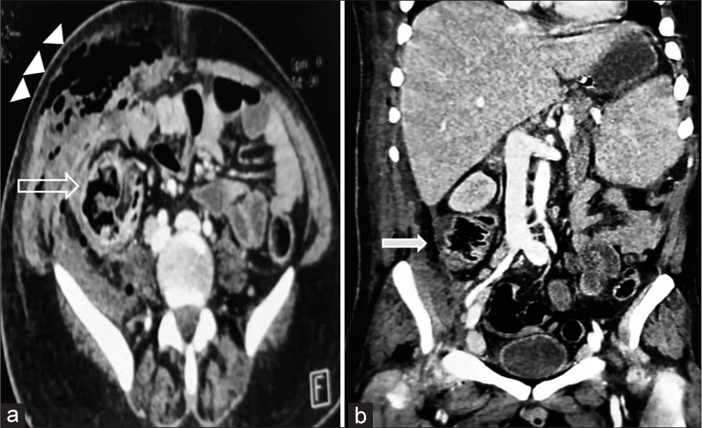 Axial (a)and coronal (b) contrast-enhanced computed tomography image showing diffuse wall thickening of caecum (open arrow) and ascending colon with pneumatosis coli and localised collection in right paracolic gutter with air foci in it s/o perforation peritonitis (solid arrow). There are also seen multiple air foci and abscess formation in the abdominal wall on right side (arrowheads).