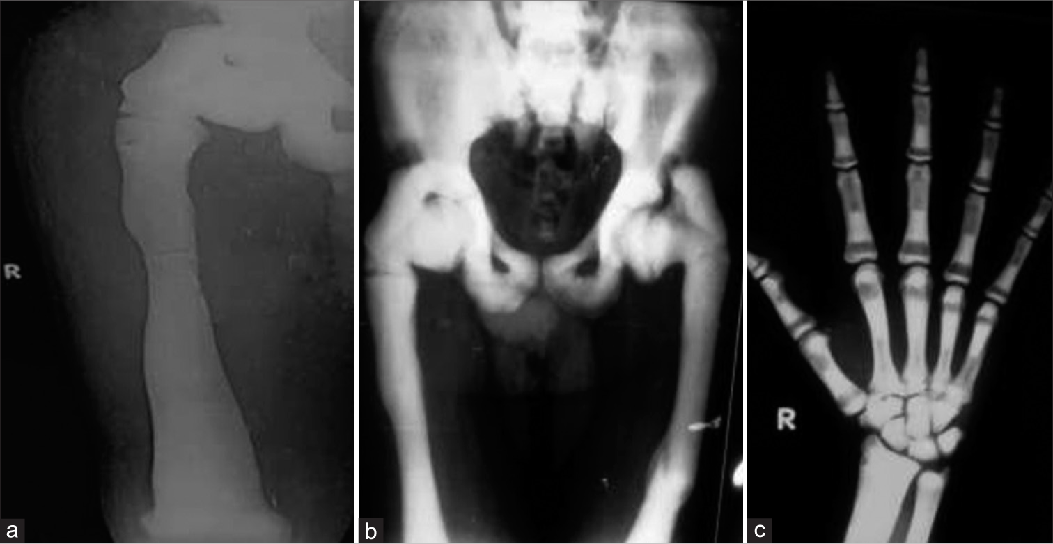 (a) X-ray right thigh showing flaring of the distal femoral metaphyses (Erlenmeyer flask deformity). There are also seen a fracture in subtrochanteric region. (b) X-ray pelvis showing bone within bone appearance in iliac crest and densely sclerotic deformed femurs with old healed fracture in femur. (c) X-ray posteroanterior view hand seen showing dense sclerosis with loss of corticomedullary differentiation and radiolucent and dense alternating lines with bone in bone appearance.
