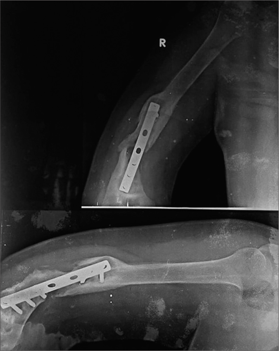 Anterior posterior and lateral radiographs of the right humerus showing nonunion with hypertrophic callus formation. Note the peri-implant lucency is more than 2 mm thick indicating hardware loosening.
