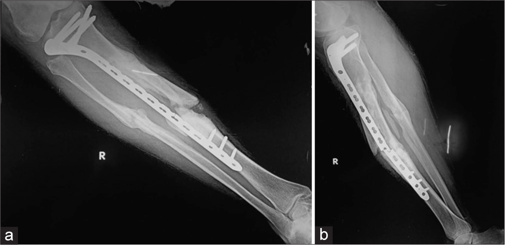 (a) Anterior posterior (AP) and (b) lateral radiograph of the leg showing buttress plate with fixation screws proximally for fracture mid shaft of the tibia, showing atrophic non-union, due to rigid fixation and distraction at the fracture site. Also note implant failure was identified clearly on lateral view only, seen as a faint fracture only on the AP view. It is seen at the screw hole, which is the weakest point in a plate. The soft-tissue density with linear opacity identified on the lateral view is artefactual.