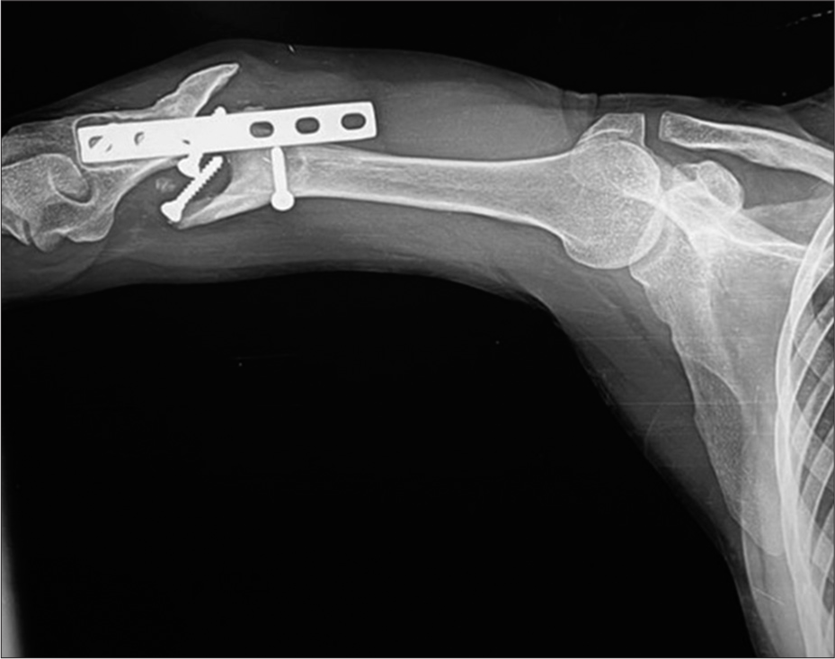 Lateral radiograph of the humerus showing oligotrophic non-union with displaced and migrated screws and plate.