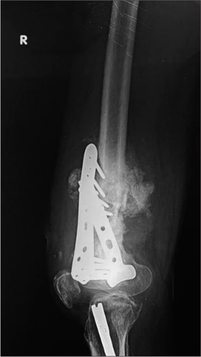 Lateral radiograph of the femur with distal buttress plates and screws showing hypertrophic callus with surrounding soft-tissue densities suggesting infection. An intramedullary nail is also seen in the proximal tibia with surrounding lucency suggestive of loosening.