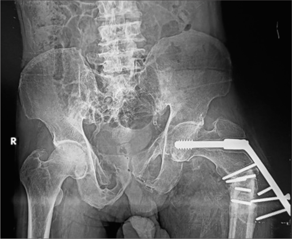 Anterior posterior radiograph of the pelvis showing dynamic hip screw (DHS) in situ. Varus deformity of the hip is seen with classical periprosthetic lucency more than 2 mm wide, displaced plate, loosening, and fracture of the screws. This suggests that the patient continued to walk on the varus hip forcing the DHS to come out leading to failure. Also, note background osteoporosis.