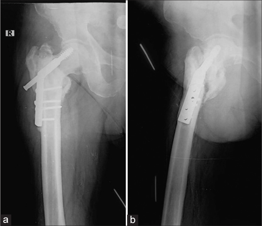 (a) Anterior posterior and (b) Lateral radiographs of the right hip with intertrochanteric fracture status post-dynamic hip screw (DHS) showing superiorly displaced/cut through and backed out DHS screw. Note the prominent periprosthetic lucencies around the screw in the head on the lateral view only and the associated non-union.