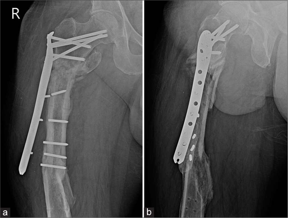 (a) Anterior posterior and (b) Lateral radiographs of the right thigh showing plate and screw failure secondary to nonunion of subtrochanteric fracture with loss of contact of the compression plate from the shaft. Old, healed, fracture shaft of the femur is seen with tracks from previous implants.
