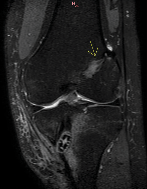 29 years male. Status post double bundle anterior cruciate ligament repair. The patient presented with discharging sinus in the proximal leg. A coronal proton density fat saturated (PDFS) image of the left knee shows a widened femoral track with the interference screw in the tibial track (yellow arrow). Adjacent altered marrow and soft tissue signal intensities suggest edema along the bio-absorbable screw.
